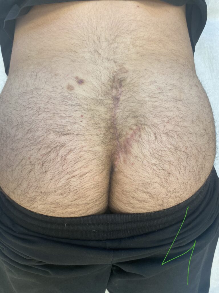 Bascom Cleft Lift surgery in UK 5 AFTER