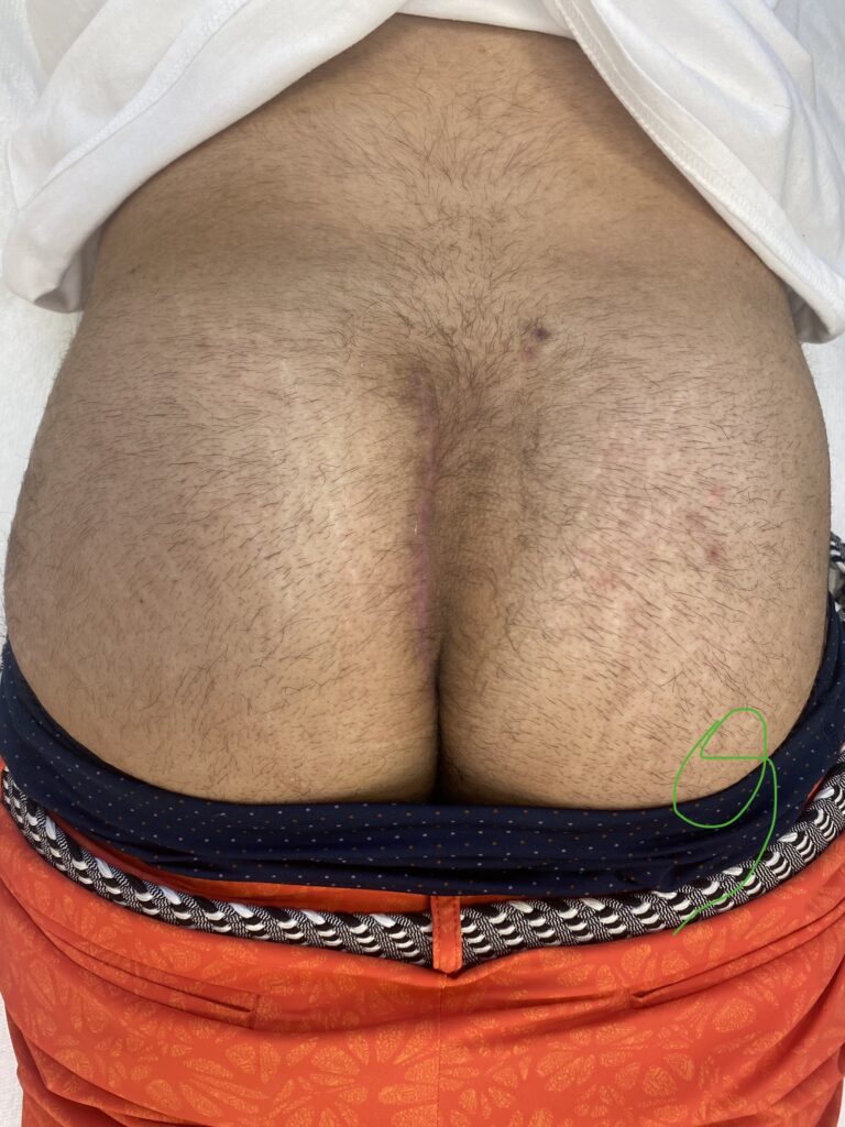 Bascom Cleft Lift surgery in UK 7 AFTER