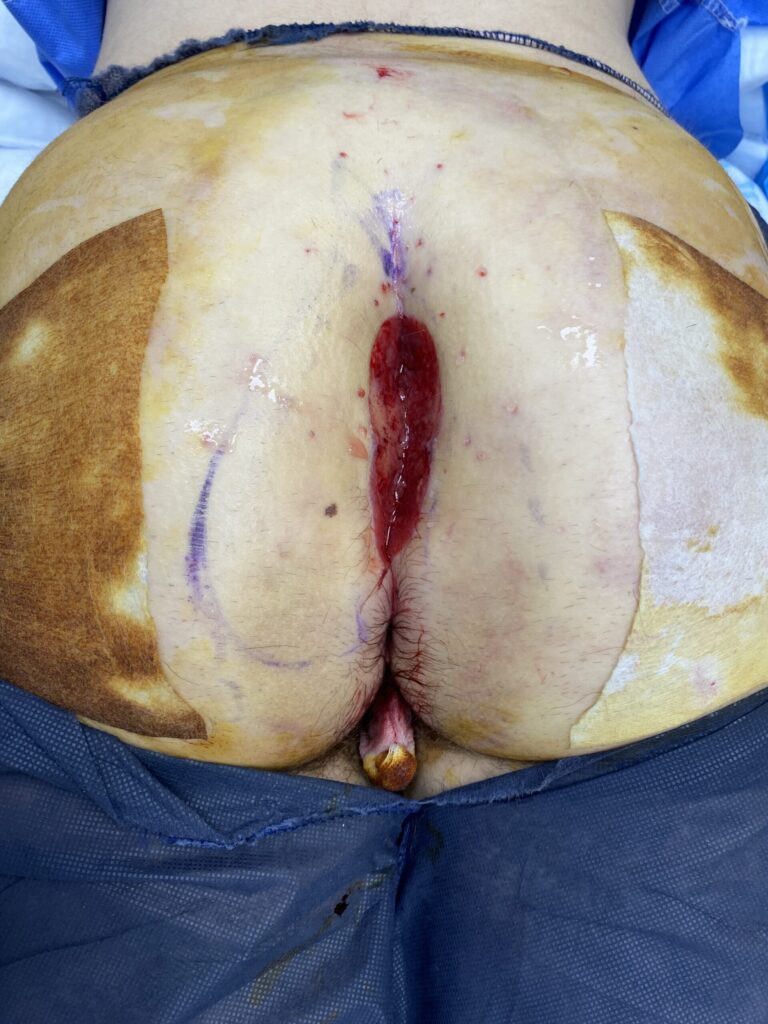 Bascom Cleft Lift surgery in UK 8 BEFORE