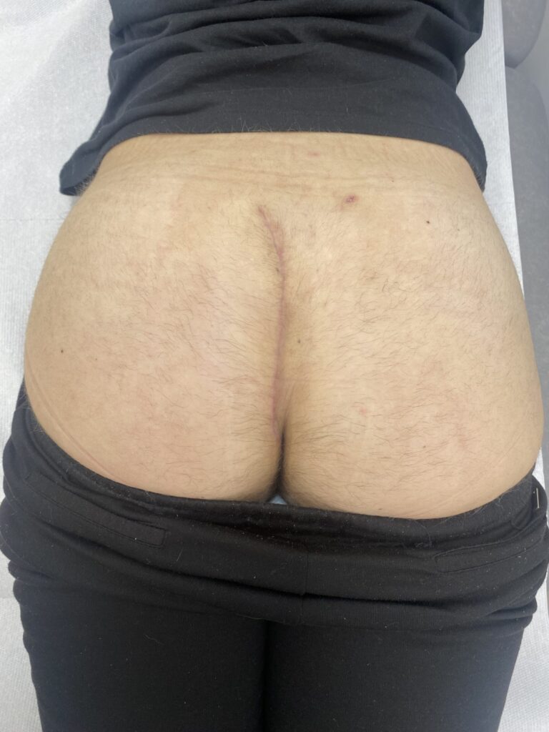 Bascom Cleft Lift surgery in UK 9 AFTER