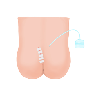 Drain removal – instruction video